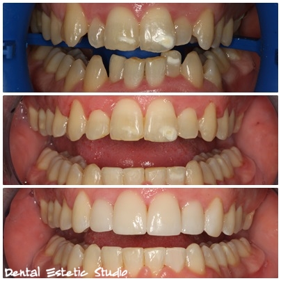 ORTODONCIJA - CLEAR BRAVICE